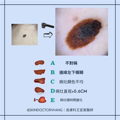 雞雞痣很多|醫示警：「冒出5種痣」致死率超高！長在這部位最危。